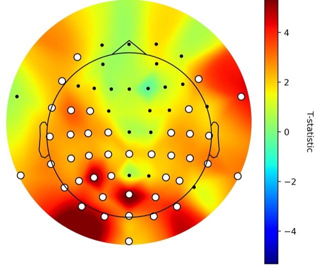 Scalp map of the increase in Lempel-Ziv complexity during chills